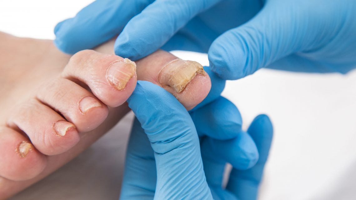 La mycose de l’ongle, une infection à traiter de manière rigoureuse