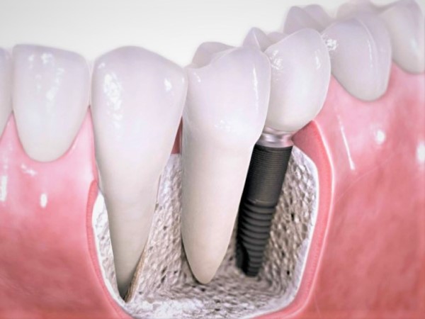 Souriez sans complexe grâce aux implants dentaires!