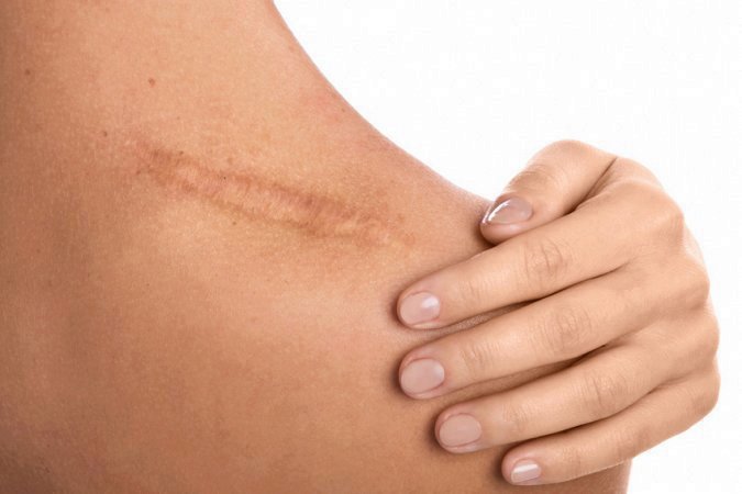 Comment améliorer une cicatrice ?