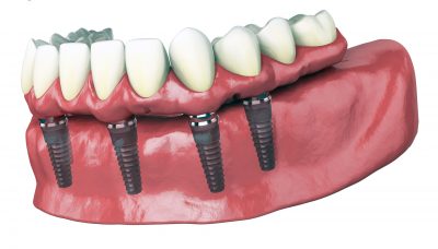 Les solutions pour remplacer une ou plusieurs dents par une prothèse dentaire