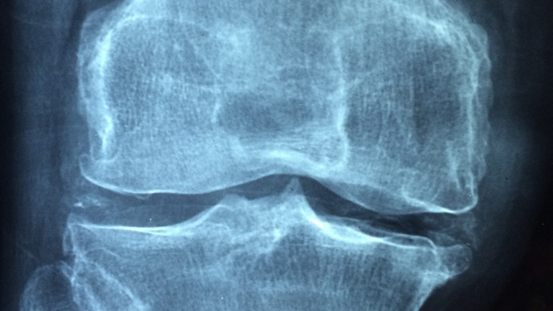 Arthrose des mains : quelques traitements non médicamenteux