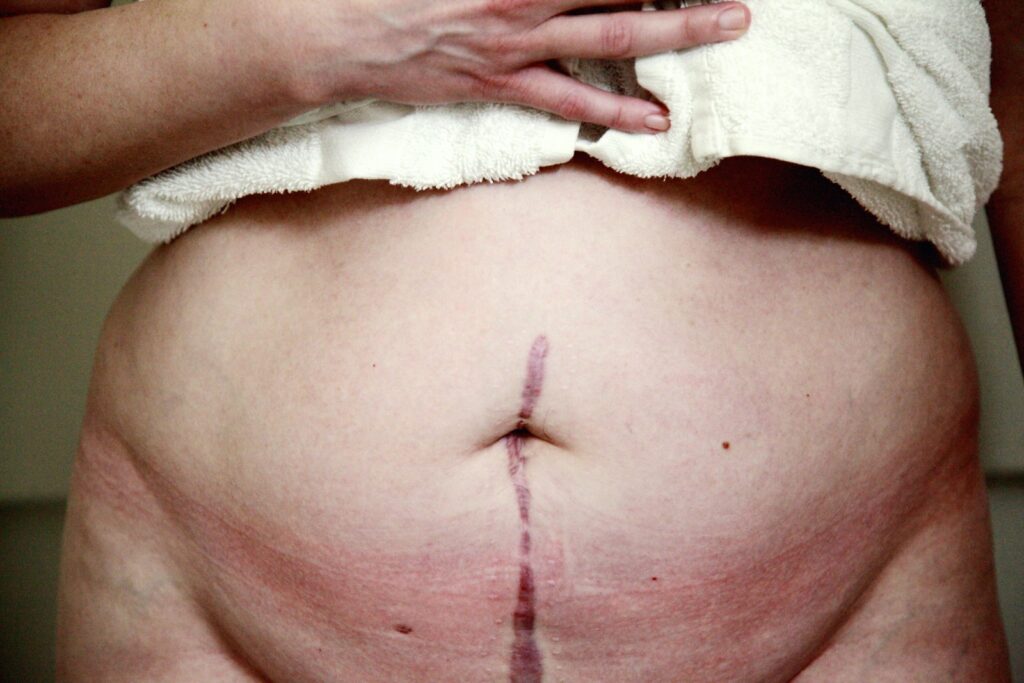 Coût détaillé d'une intervention d'abdominoplastie