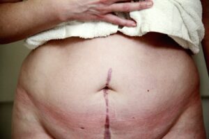 Coût détaillé d'une intervention d'abdominoplastie