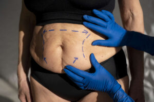 remboursement-abdominoplastie