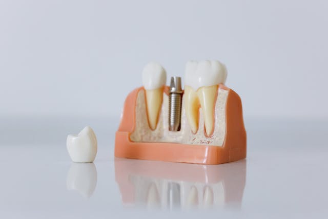 Implant dentaire Tunisie : technique, coût et récupération